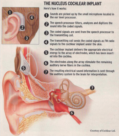 cochlear